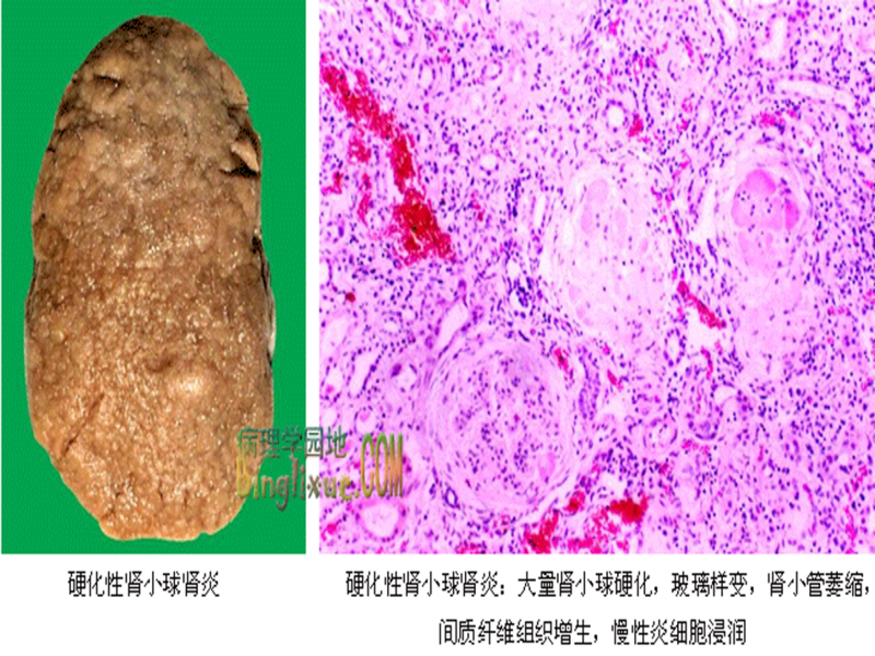 文件:34号切片-慢性肾小球肾炎-大体观.png