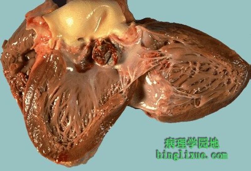 文件:20号切片-风湿性心肌炎-大体观.jpg