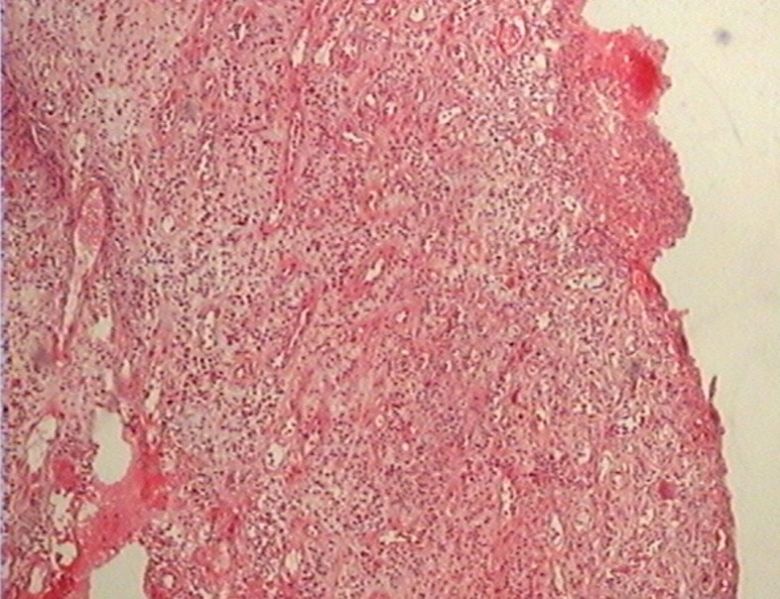 文件:4号切片-肉芽组织-镜下观1.jpg