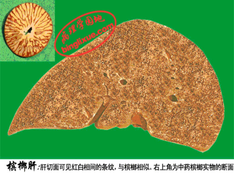 文件:6号切片-慢性肝淤血-槟榔肝大体观.png